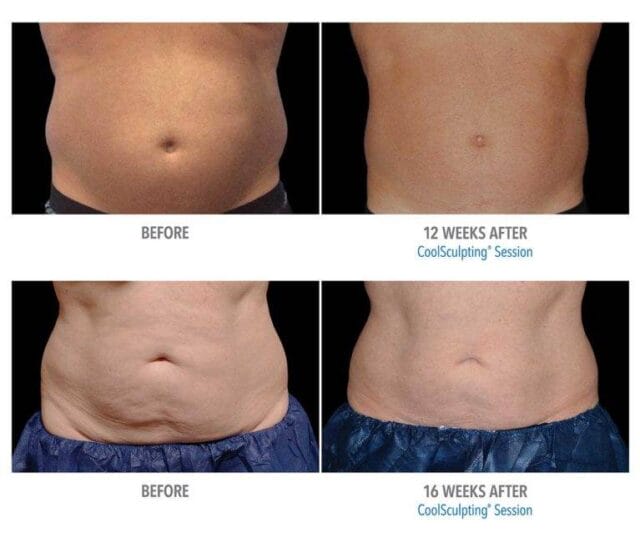 Dr. Melinda Silva MD coolsculpting before and after