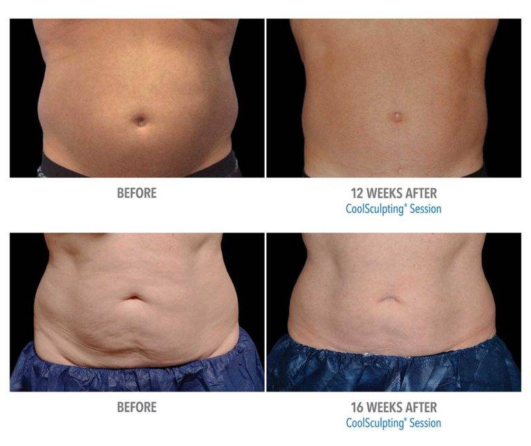 Dr. Melinda Silva MD coolsculpting before and after
