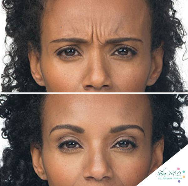 Dr. Melinda Silva MD botox filler before and after