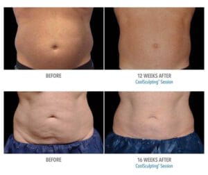 Dr. Melinda Silva MD - CoolSculpting Before and After Results image