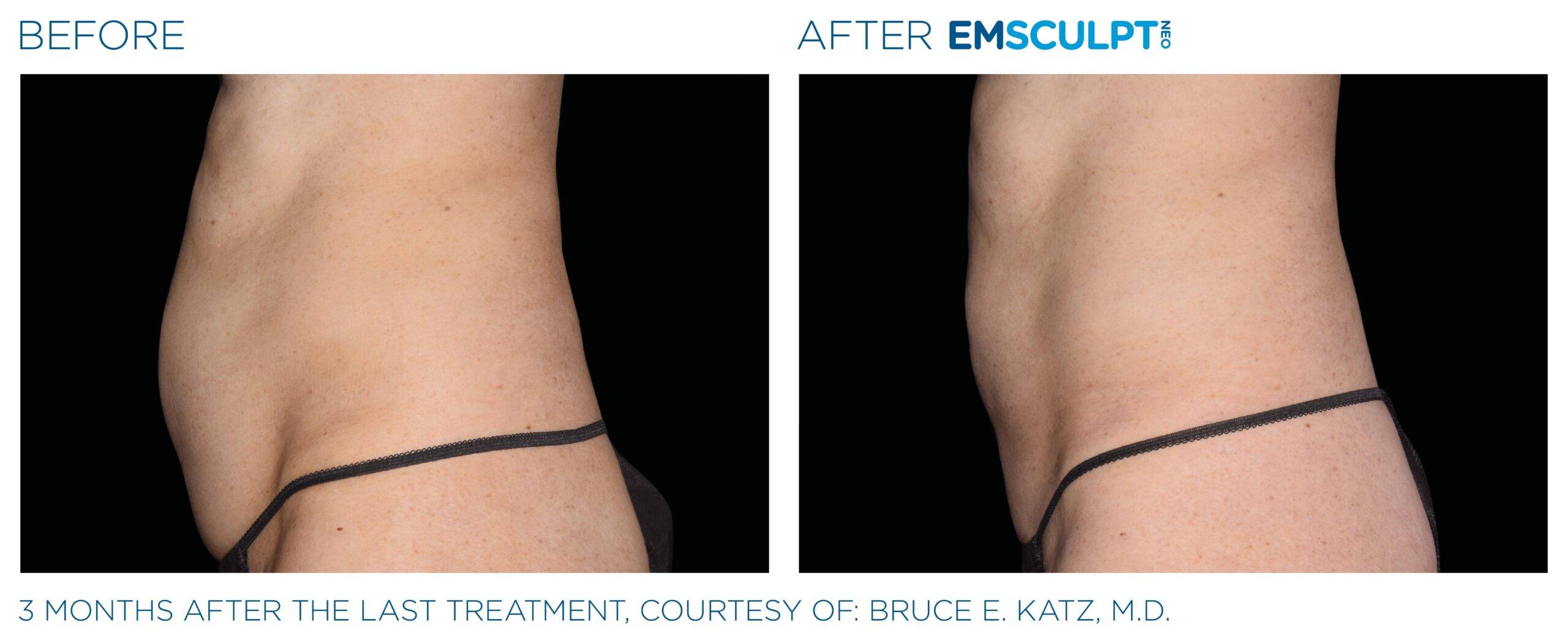 What Is the Best Emsculpt Cost in San Diego? - A New You Aesthetics