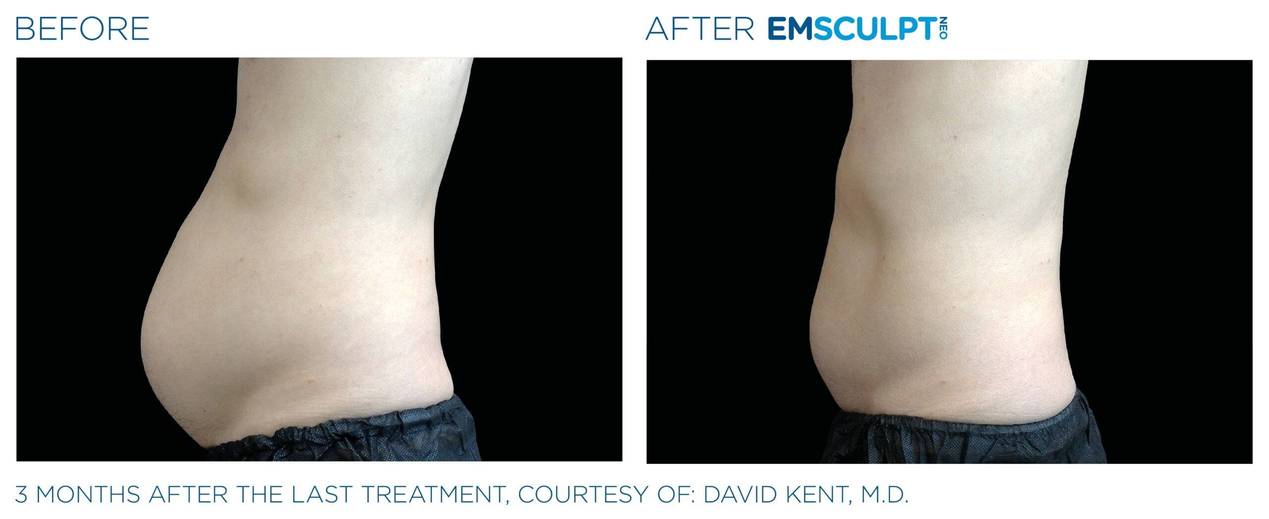 Dr. Melinda Silva MD - Result Using Emsculpt Stomach side Image