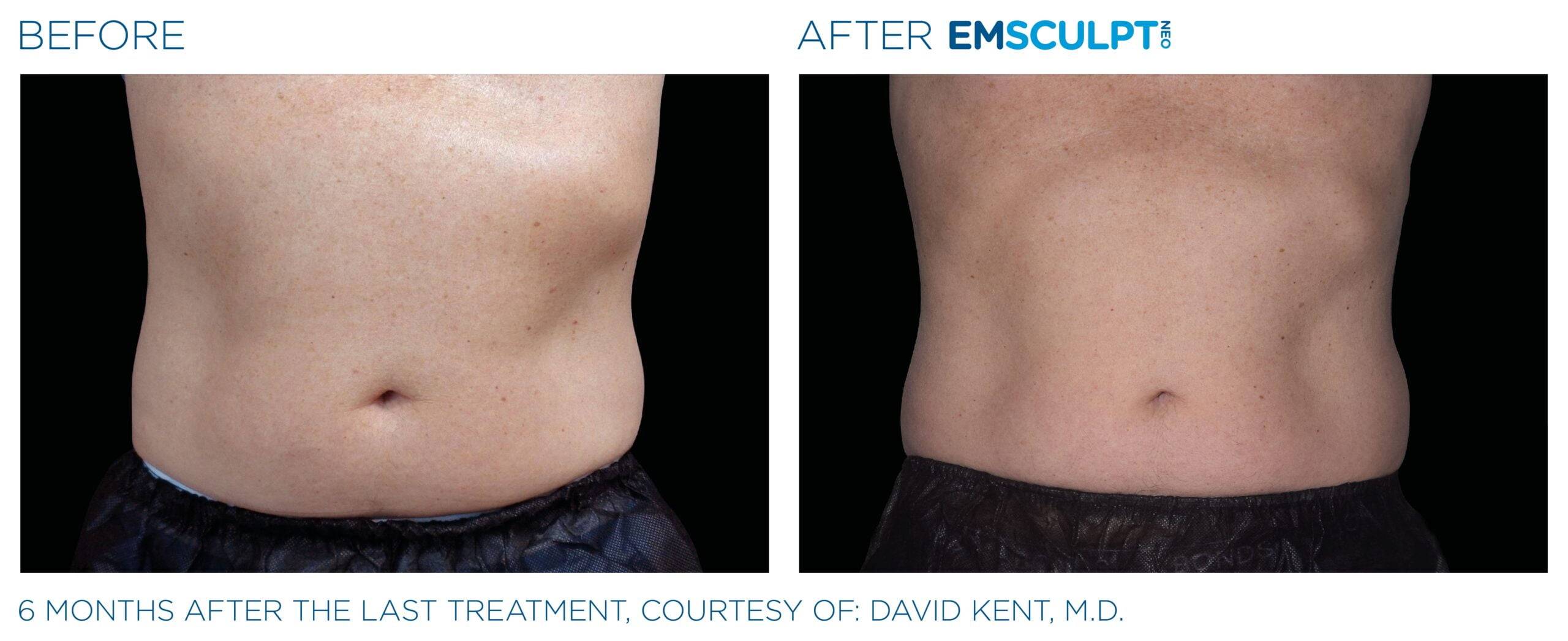 Dr. Melinda Silva MD - Result Using Emsculpt Stomach Front Image
