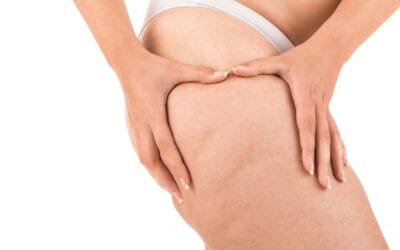 Top 7 Advantages of Using Coolsculpting® to Reduce Cellulite