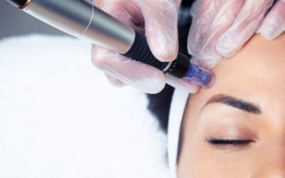 Discover the Power of Vivace™ Microneedling RF for Youthful, Radiant Skin